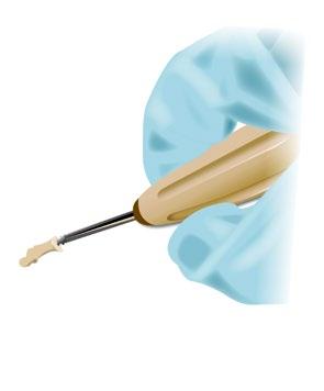 Deliver the Taper Lock Pin into the proximal screw using the Taper Delivery Tool.