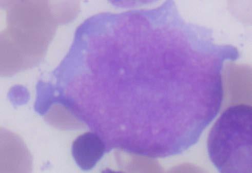 expression of HLA-DR, CD38 Abnormal expression of lymphoid markers Abnormal