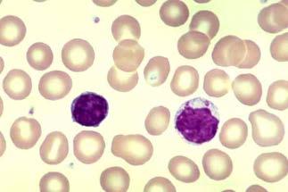 platelets Lymphocytes Erythropoiesis Abnormal expression of CD36 and CD71