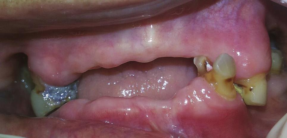 In other cases, there may not be enough teeth present to support a fixed prosthesis.