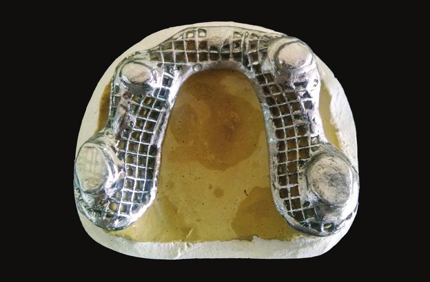 Porcelain fused to metal crowns were fabricated cemented on the prepared teeth using glass ionomer cement.