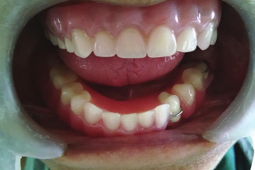 Maxillomandibular relation was recorded with wax occlusal rims on temporary denture bases fabricated on the mandibular master cast and the maxillary metal