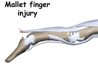 which allows the DIP joint to get pulled downward into flexion. As the DIP joint flexes and the PIP joint hyperextends, the swan neck deformity occurs.