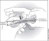 com 49 SKIER S THUMB Disruption of the UCL cased by forced abduction of the MCP joint Partial or complete tear