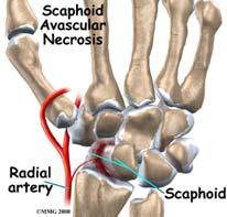 SCAPHOID FRACTURE MANAGEMENT Complications are difficult to manage Blood supply