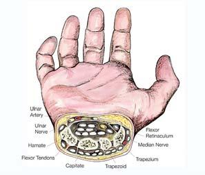 CARPAL TUNNEL SYNDROME Common 2.7-5.