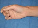 com 65 GANGLION CYST Arises from the capsule of the joint or tendon synovial sheath Thick, clear, mucinous material One-way valve Dorsum of wrist,