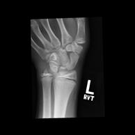 CASE #12 9 y/o female gymnast Progressive bilateral wrist pain made worse with wrist in extension such as when tumbling, vaulting, and back walkovers Normal ROM with swelling of the