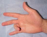 OBSERVATION/INSPECTION: CHRONIC Trigger finger Dupuytren s Disease Med.und.edu Healthtap.