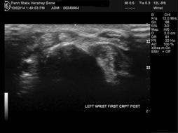 org 22 DE QUERVAIN S TENOSYNOVITIS Swelling/stenosis of the sheath that