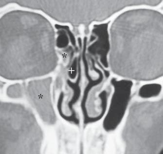 There is a discrete mucous thickening on the floor of the maxillary sinus. Figure 3. Coronal CT at the level of the osteomeatal complex.