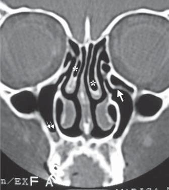 unciform process (+), ethmoidal bulla (*), infundibulum (arrow). Note the slight nasal septum deviation to the left. Figure 6.