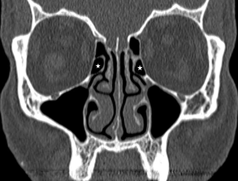Figure-1: Bilateral agger nasi cell (white star mark inside) Figure-4: Superior attachment of uncinate process reaching higher up in skull base on right
