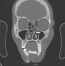 CT scan PNS coronal section showing concha bullosa on the right