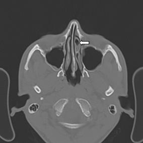 CT scan PNS coronal section.