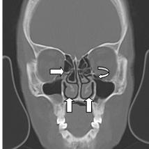 Overexpansion of the ethmoid sinus on right side (Horizontal