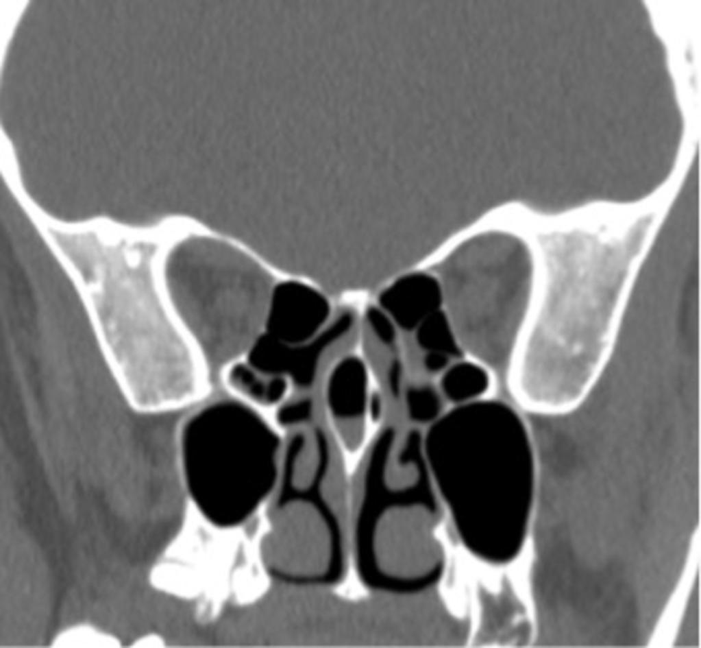 Fig. 2: Coronal reformatted CT image shows