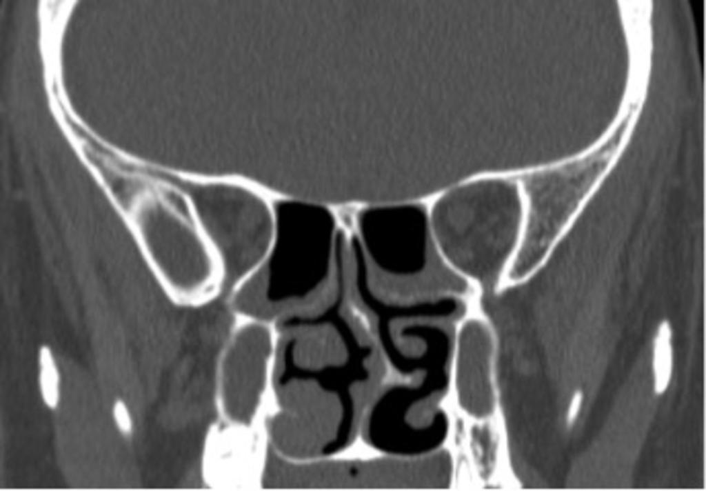 Fig. 3: Coronal CT image shows