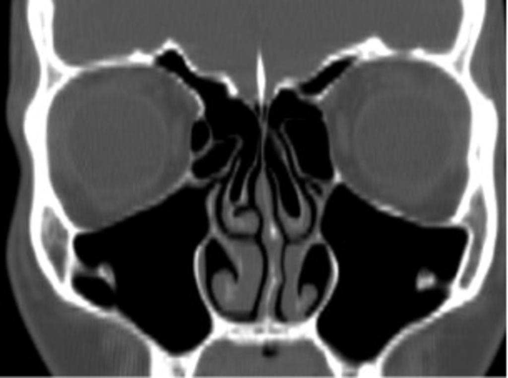 Fig. 5: Coronal reformatted CT image