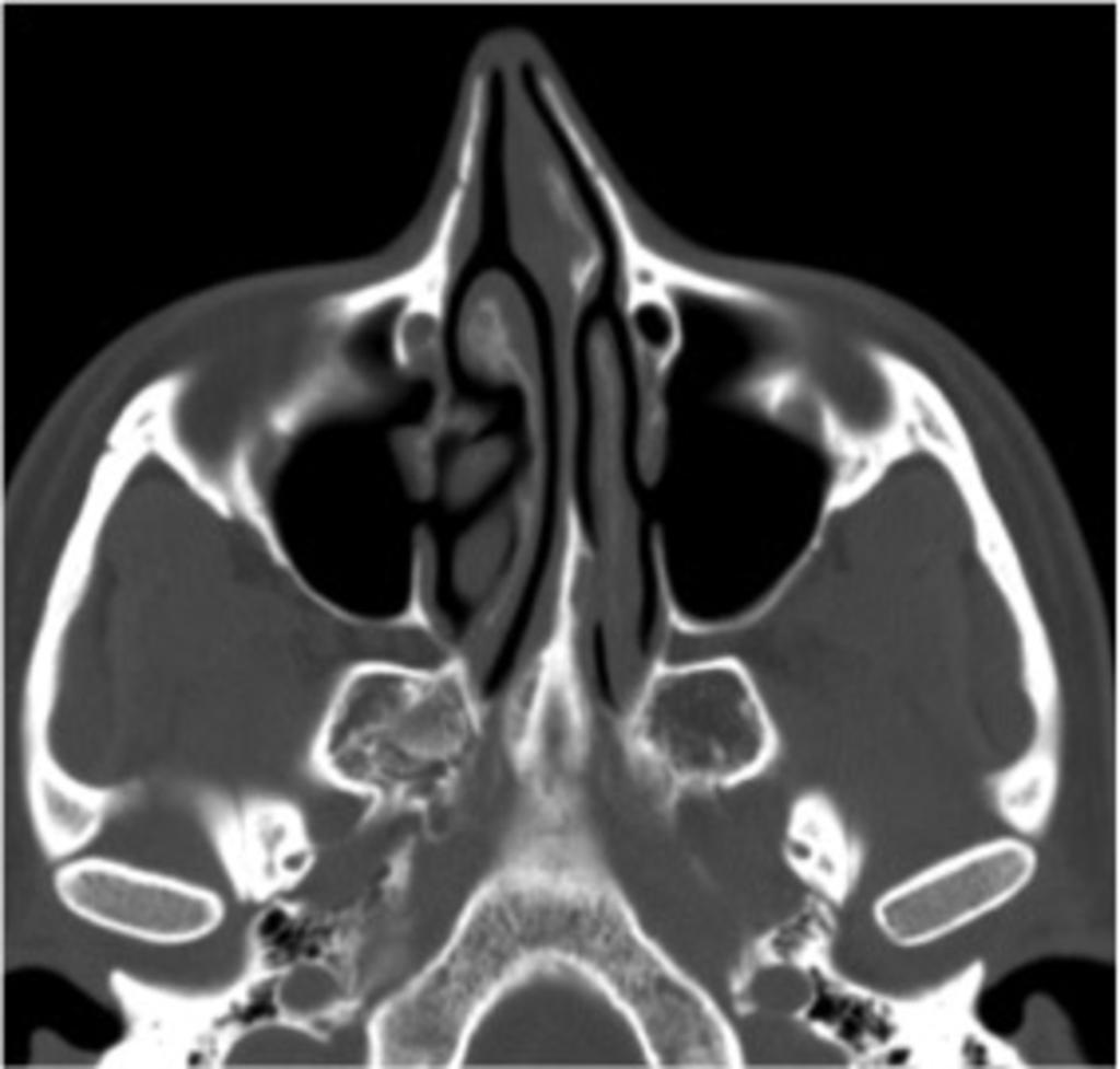 Fig. 11: Axial CT image shows bilateral
