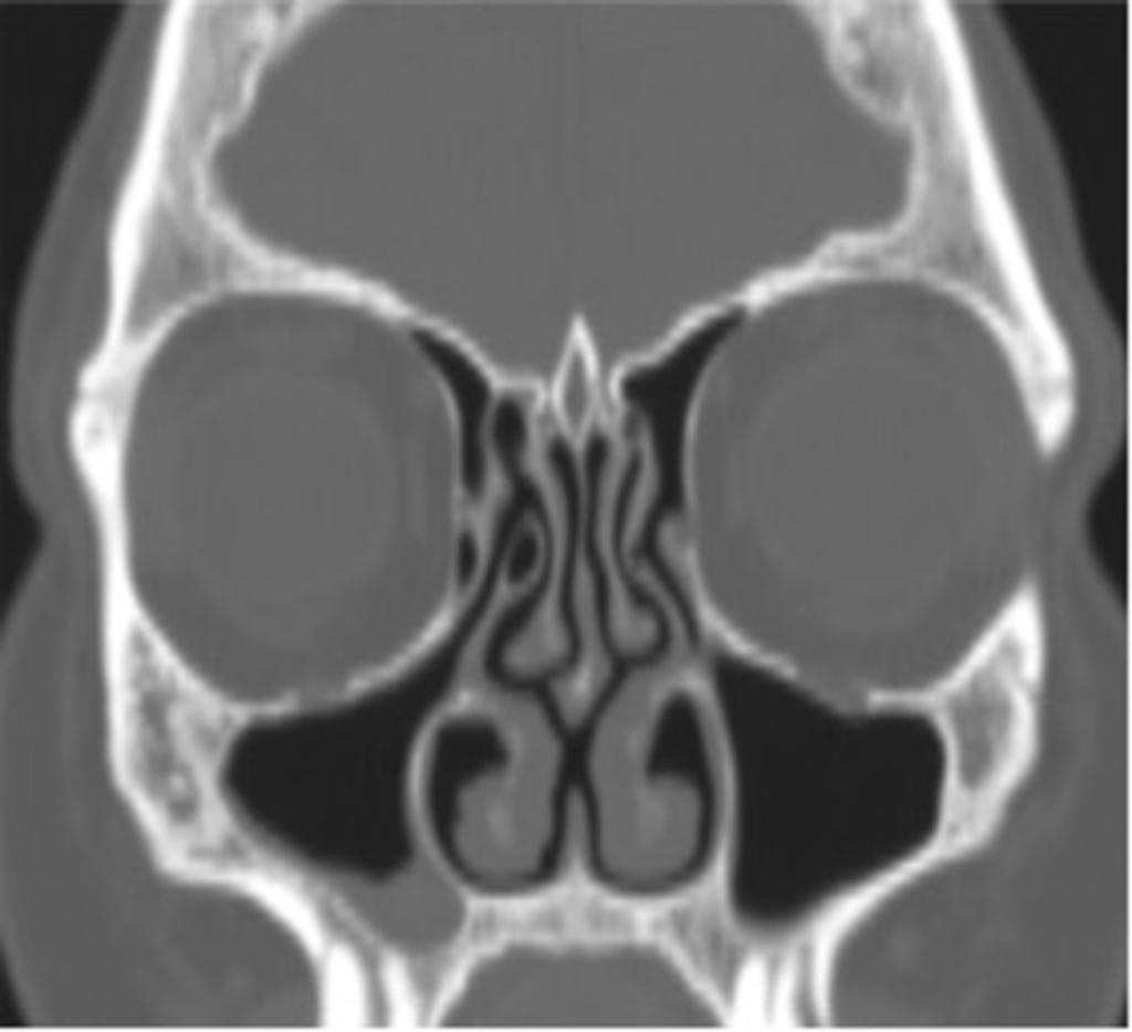 Fig. 13: Coronal reformatted CT