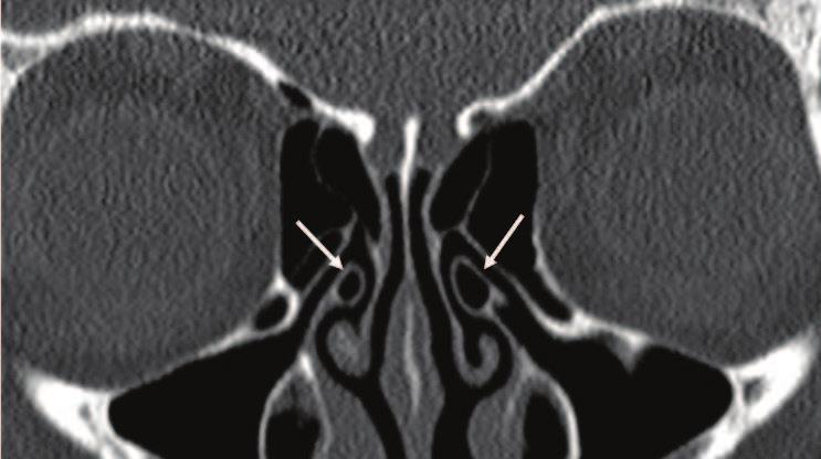 Paranasal Sinus Anatomy: What the Surgeon Needs to Know http://dx.doi.org/10.5772/intechopen.69089 11 Figure 7. Coronal CT scan showing bilateral pneumatized uncinate process uncinate bulla (arrows).