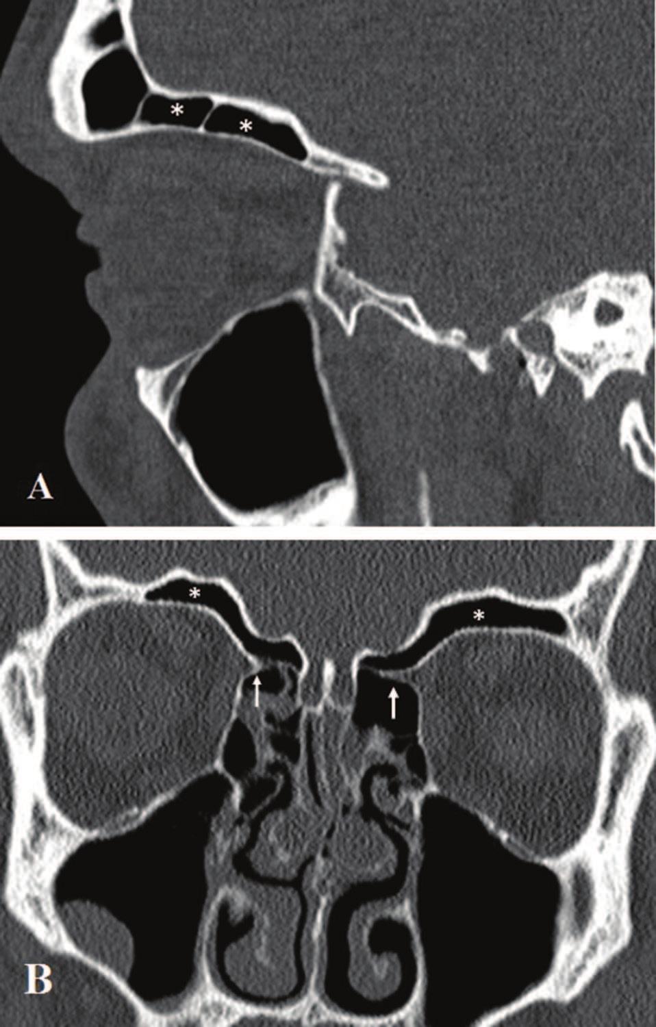 22 Paranasal Sinuses Figure 16. (A) Parasagital CT scan showing an extension of pneumatization over the orbit (asterisks).