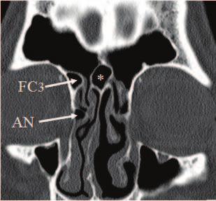 28 Paranasal Sinuses Figure 21. Parasagital CT scan showing frontal bullar cell (FBC). Note that the posterior border of the cell is related to the anterior cranial fossa.