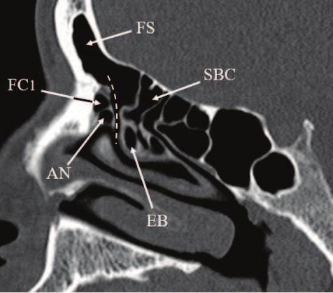 Paranasal Sinus Anatomy: What the Surgeon Needs to Know http://dx.doi.org/10.5772/intechopen.69089 29 Figure 23. Parasagital CT view of the frontal recess (dashed line).