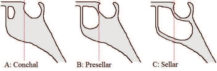 Paranasal Sinus Anatomy: What the Surgeon Needs to Know http://dx.doi.org/10.5772/intechopen.69089 31 Figure 25.