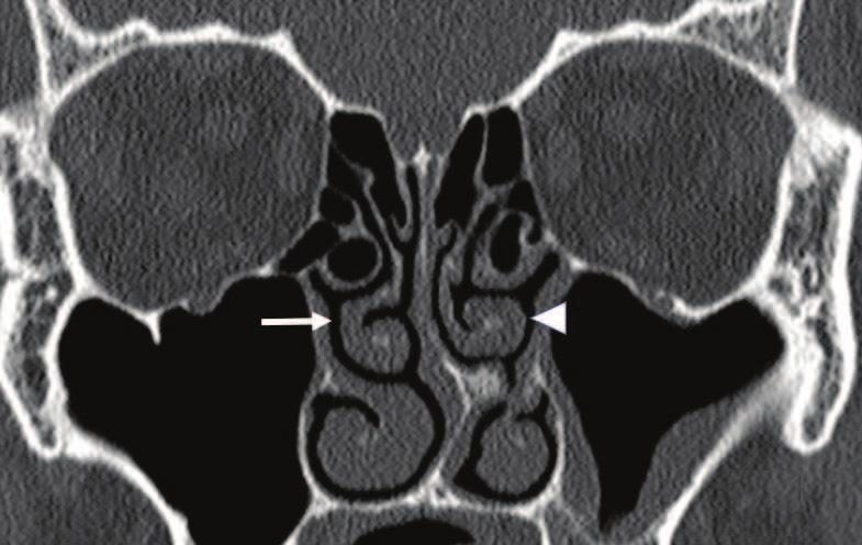 8 Paranasal Sinuses Missed basal lamella: When the basal lamella does not atach to the lamina papyracea, it ataches to the lateral maxillary sinus wall.