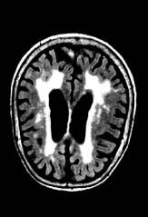 For this reason any patient with a dementia syndrome with multiple lacunar infarcts in the basal ganglia on MRI but without hemispheric lesions cannot be diagnosed as having vascular dementia
