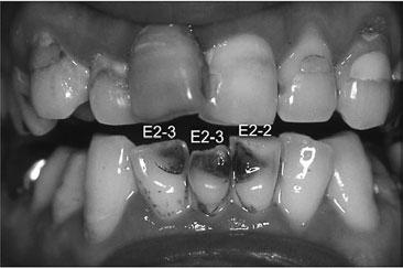 No development of dental erosion was identified in the maxillary