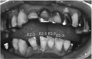 Prevalence of erosion in the mandibular central incisors was