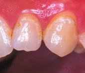 ORTHODONTICS Dr Hayashi Yokohama, Japan Recaldent CPP-ACP has been shown to have a dramatic effect on white