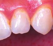 This series of clinical photographs was provided by an orthodontist who used a prototype paste containing 5%