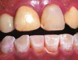 TREATMENT OF FLUOROSIS WITHOUT MICROABRASION Prof.