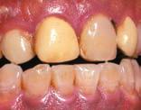 enamel abrasion was the preferred method of enamel treatment before application of Tooth Mousse.
