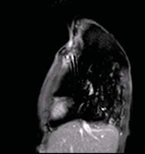 RV-PA conduit Echo shows dilated RV MRI
