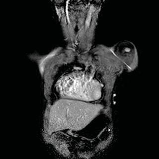RVOT Cine FTE Sedated 5-year-old boy freely breathing with h/o TOF / PA Plan scan for flow quantification of MPA Cine phase contrast Shortest TE, TR = 10