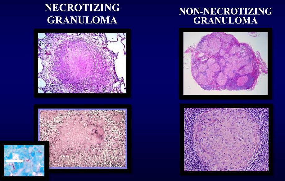 Morphology of Granulomatous Inflammations The first image (left) shows a lung alveolus in which necrosis is taking place.