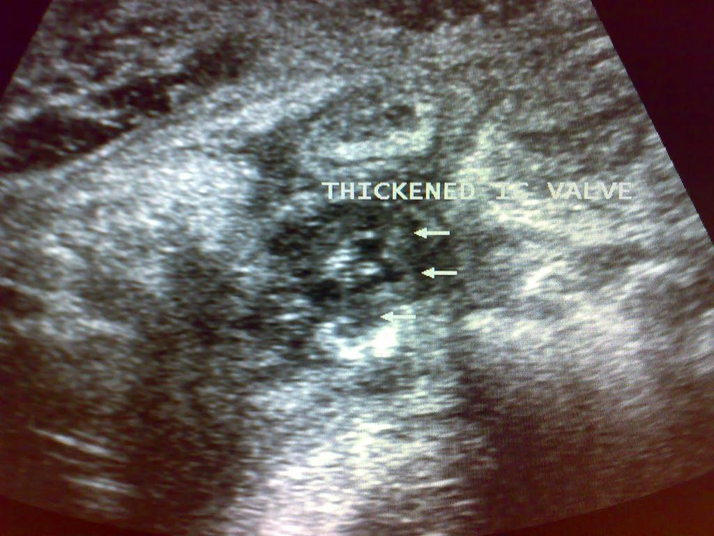Fig. 12: Thickening of the ileocecal valve in