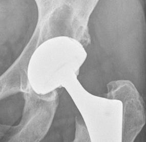 Osteolysis Osteolysis is one of the major failure mode of cemented and uncemented acetabular fixation [1] It is a consequence of the biological reaction of bone to ultra-high-molecular-weight