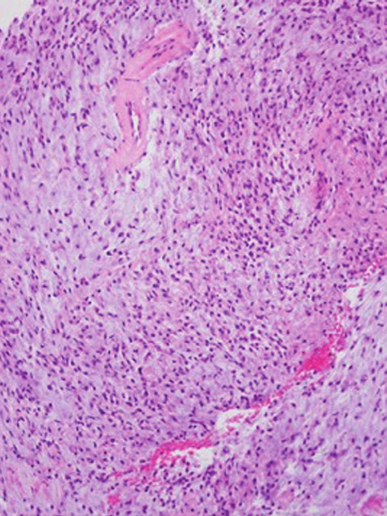 Ki-67 lbeled only few nuclei of the squmous epithelium. The deep surgicl border ws very close to the tumor boundry. The ptient ws dischrged in hours.