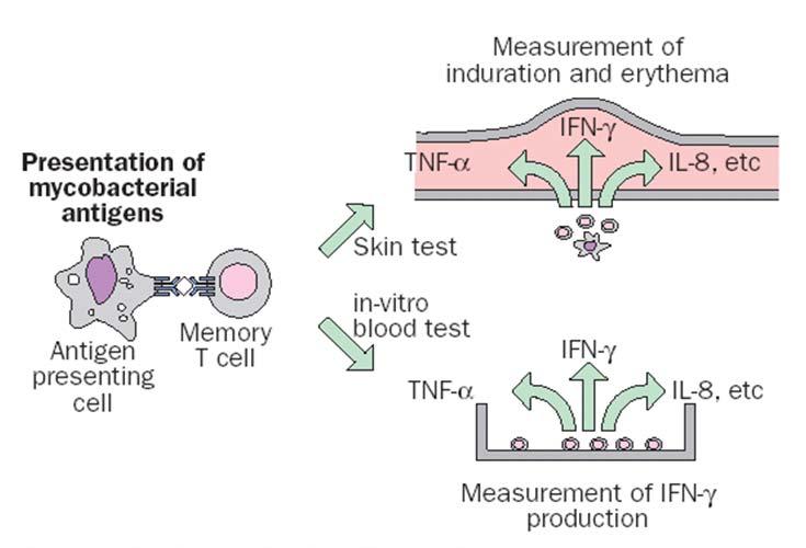 TST Limitations Technical problems in administration and reading Interpretation based on pretest probability >1 visit needed False-negative responses Anergy (compromised immunity) TST reversion at