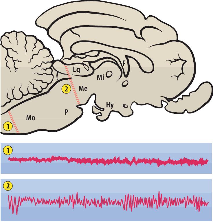 1: encephale isolé 2: cerveau isolé Consequences of lesions Basal forebrain - insomnia Post.