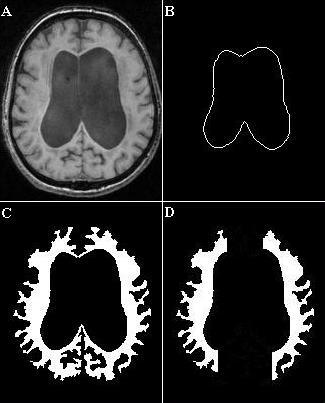 Periventricular white matter analysis Slices at the level of the lateral ventricles and above the caudate nucleus (no intervening grey matter to the cortex) White