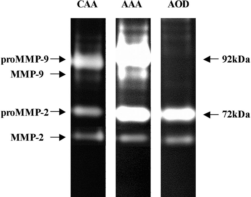 Representative example of MMP-2 and MMP-9 activity under latent or activated forms measured by gelatin zymography in extracts of normal (CAA) and