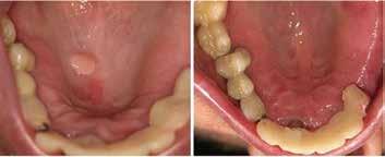Successful implantology treatments require implants to be stable and