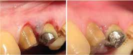 dentistry s two most effective laser wavelengths: ASP Er:YAG and Nd:YAG.